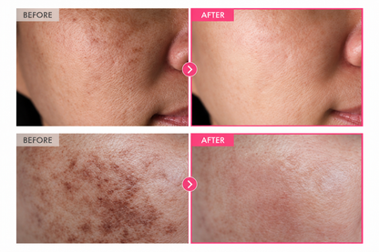Before-and-after comparison of an Indian woman's facial skin showing the appearance of dark spots, pimple marks, and uneven skin tone.